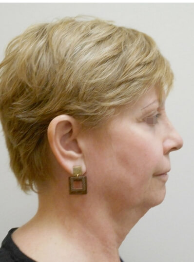 Real patient before facelift photo