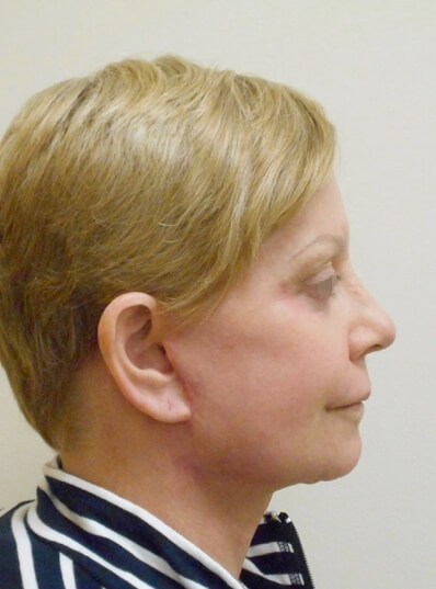 Real patient after facelift photo