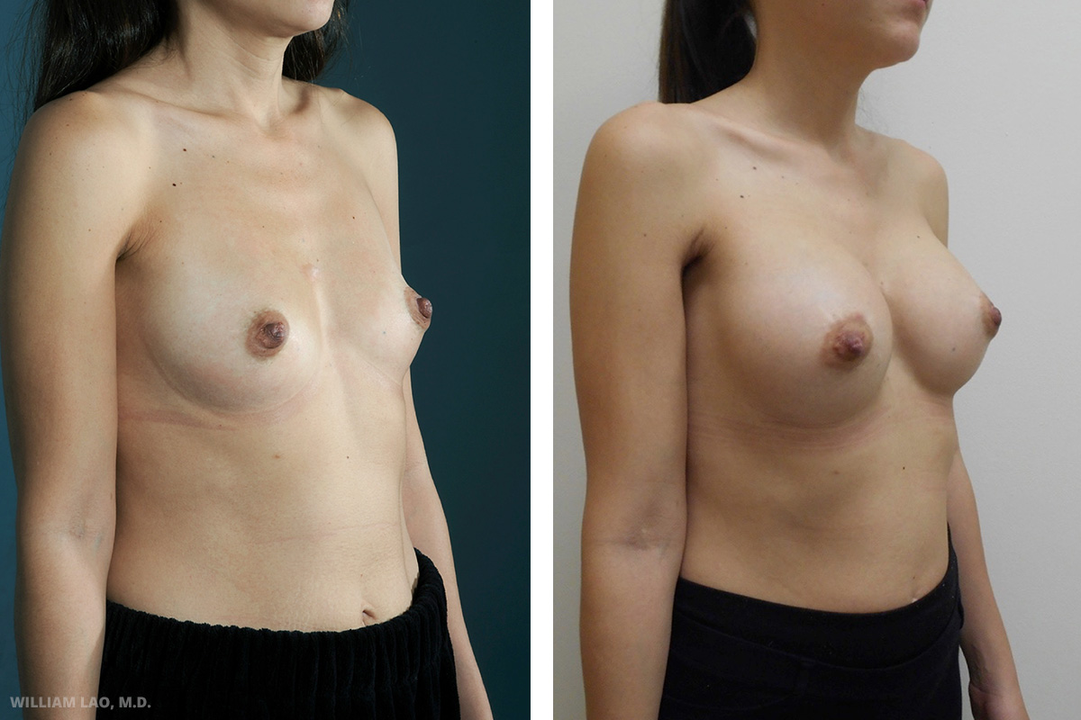 Breast augmentation before and after results as performed by New York City plastic surgeon Dr. William Lao