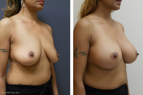 Breast augmentation before and after results as performed by New York City plastic surgeon Dr. William Lao