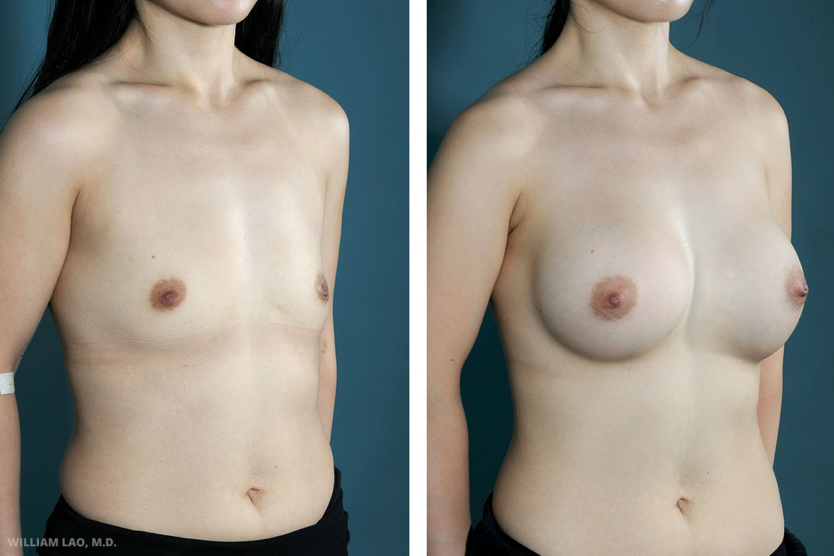 Breast augmentation before and after results with silicone implants as performed by New York City plastic surgeon Dr. William Lao