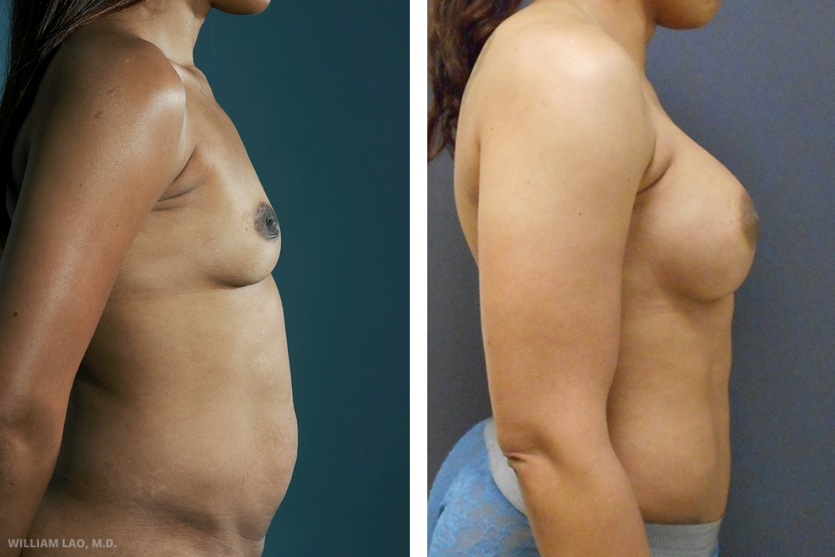Breast procedure before and after results as performed by Manhattan plastic surgeon Dr. William Lao