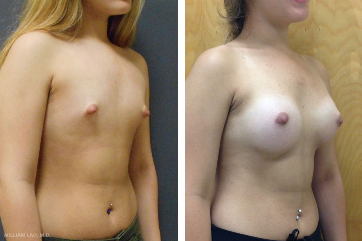Breast implants before and after results as performed by New York City plastic surgeon Dr. William Lao