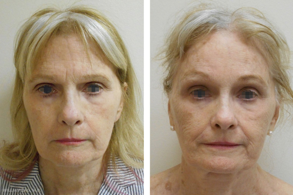 Before and After results of a brow lift performed by New York surgeon Doctor William Lao