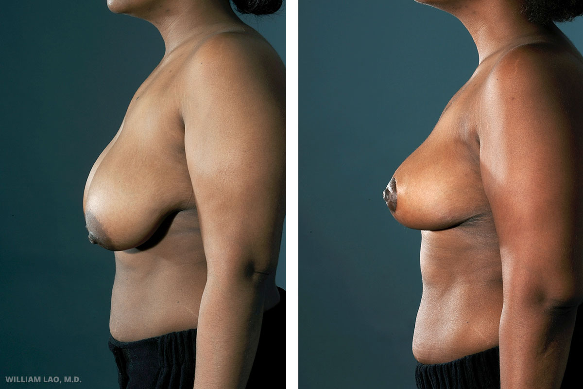 Breast Reduction NYC
