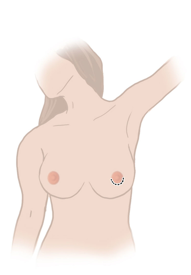 Breast implants can be inserted through the areola, hiding the breast augmentation incision