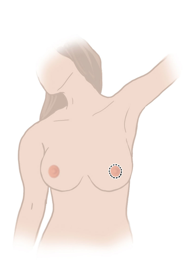 Breast lift incision around the areola