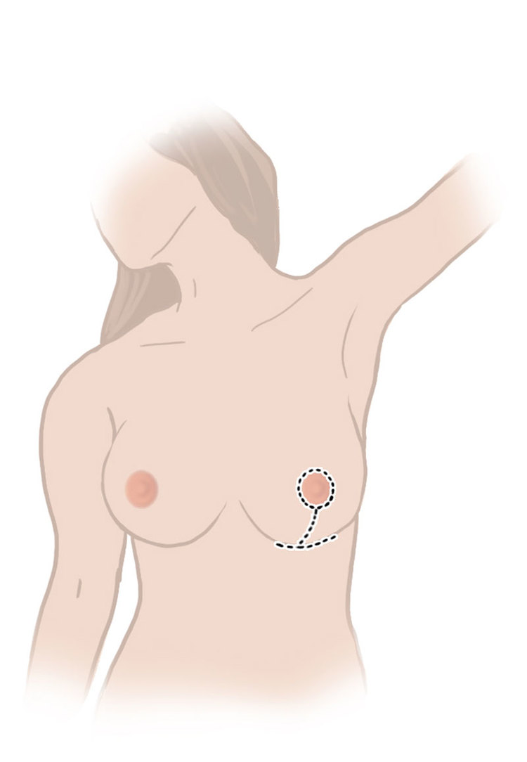 Breast lift inverted T and areola incision