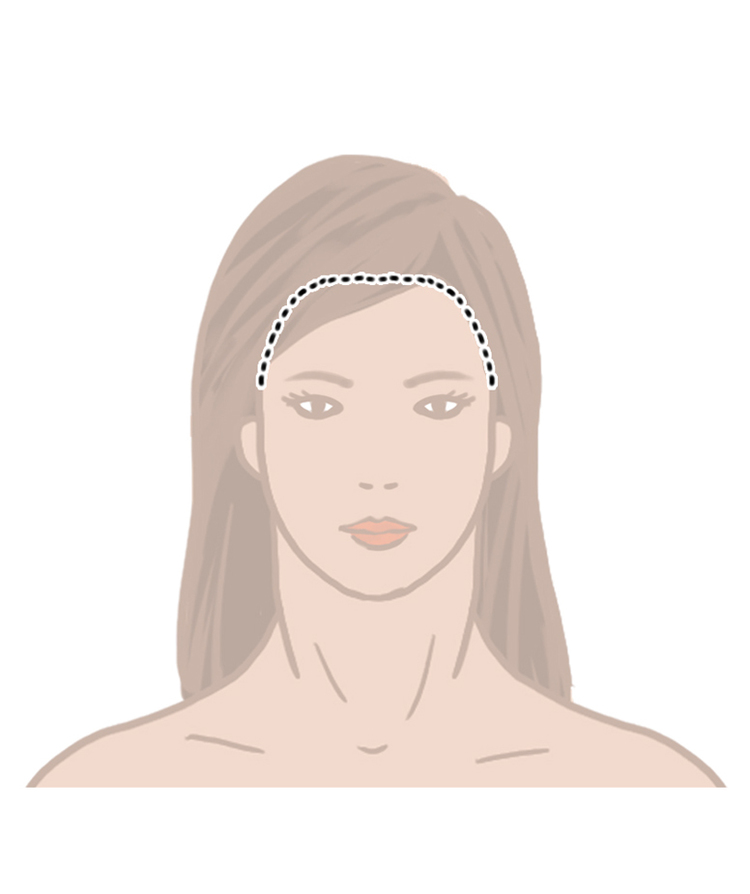 A brow lift or forehead lift incision can be hidden in the hairline
