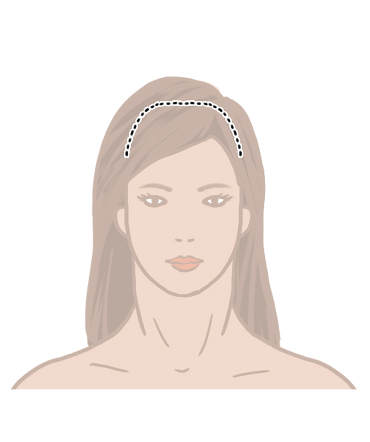 A brow lift or forehead lift incision can be hidden behind the hairline