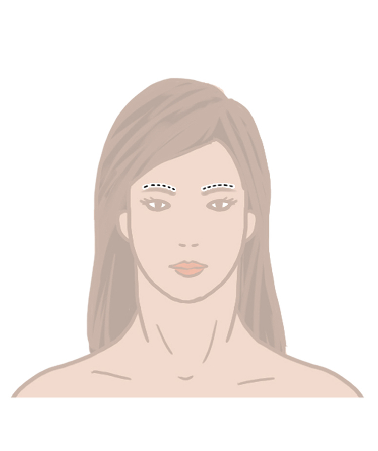 A brow lift of forehead lift incision can be hidden right above the brow