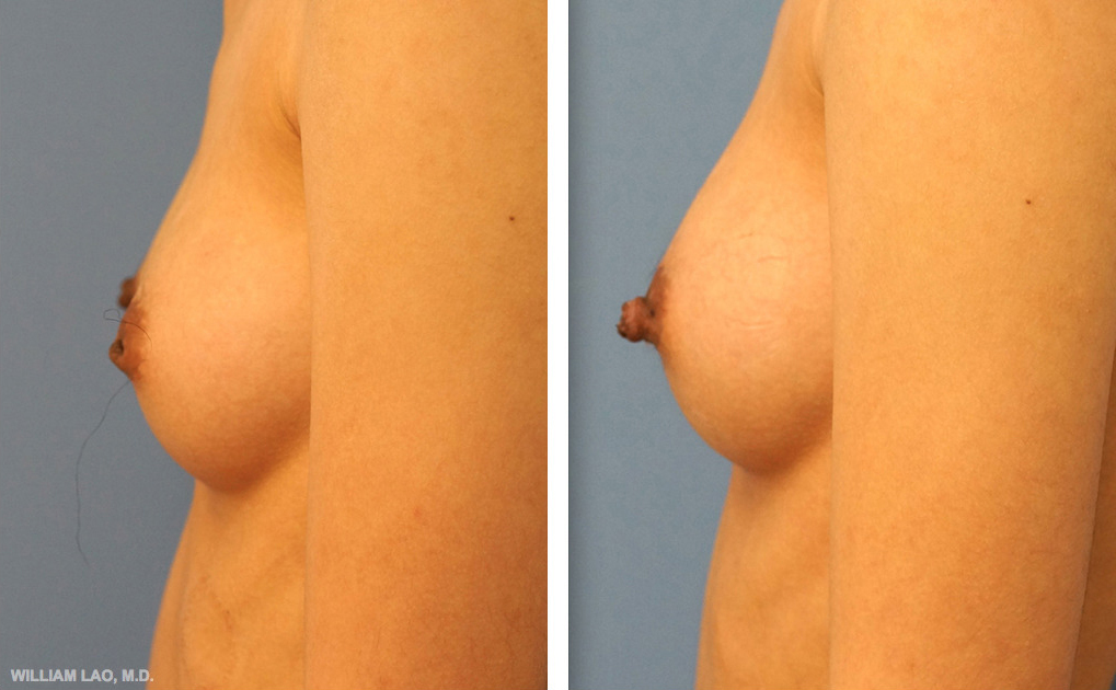 Before and After Nipple Inversion NYC