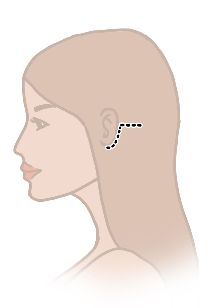 Neck Lift incisions can be hidden behind the ear