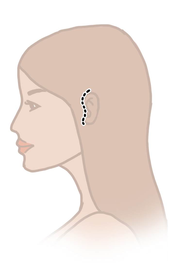 Facelift Incision in front of the Ear
