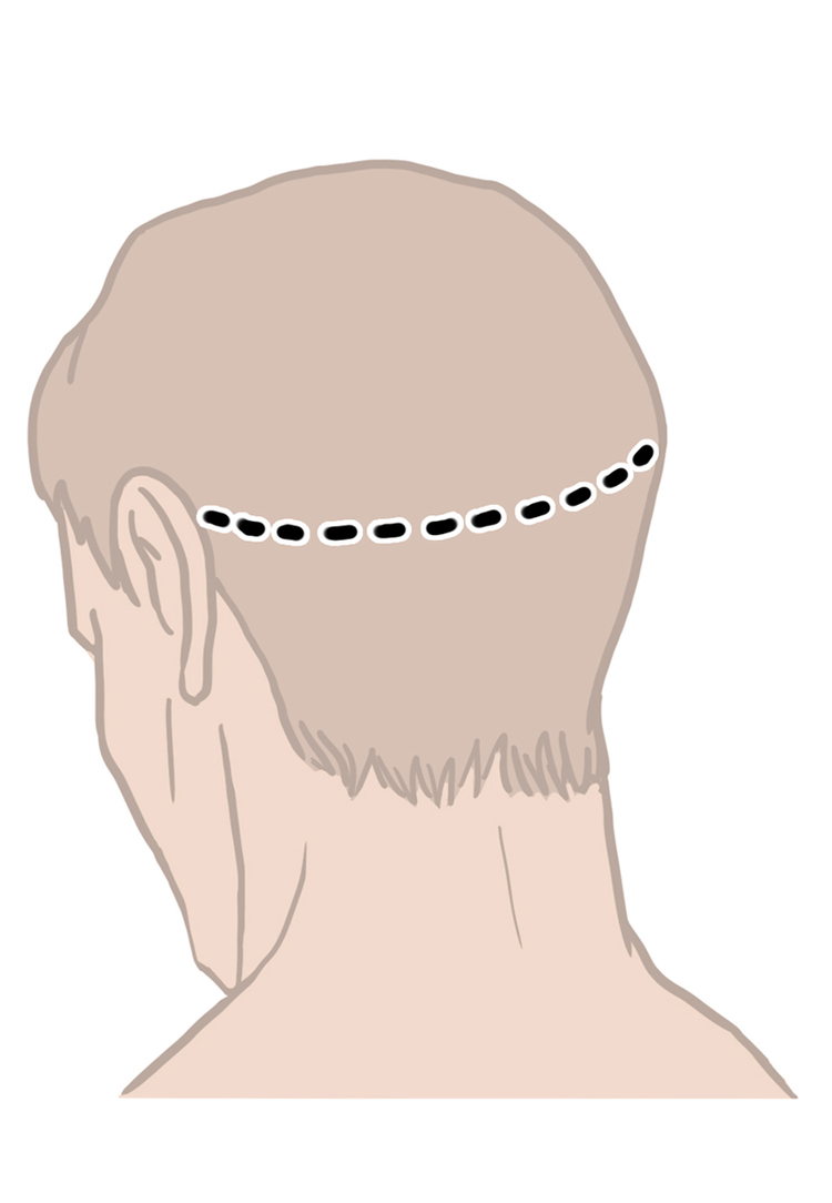 Traditional Incision for Hair Transplant