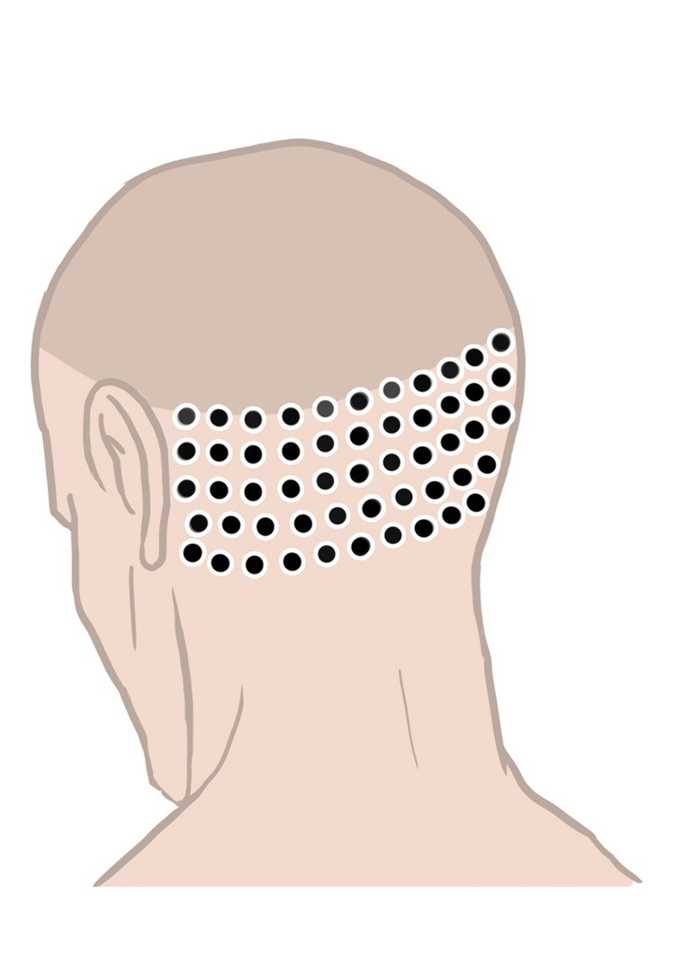 FUE (Follicular Unit Extraction) Pinpoint Incisions
