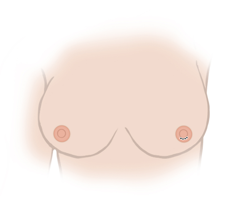 Nipple Reduction NYC