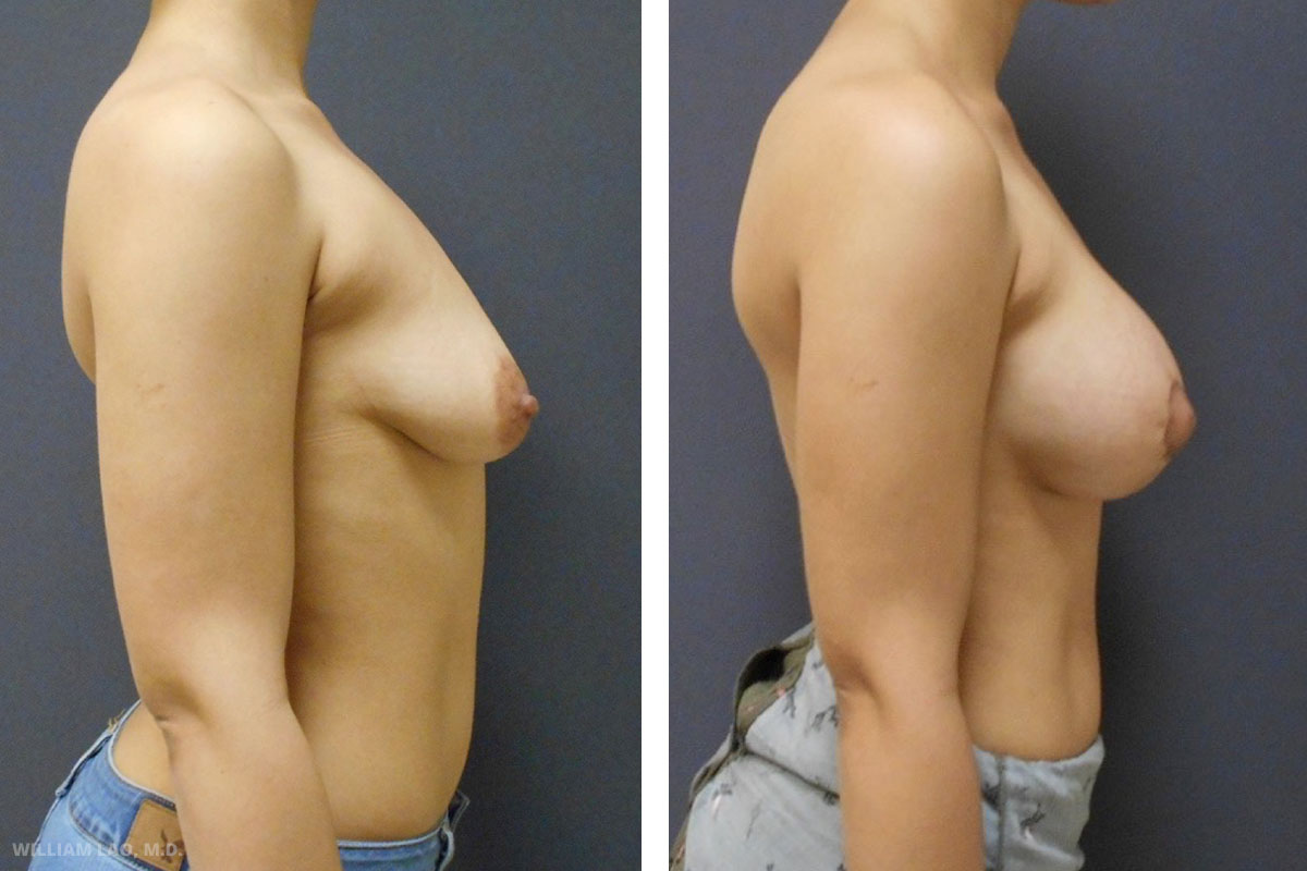 Before and After Breast Augmentation Manhattan