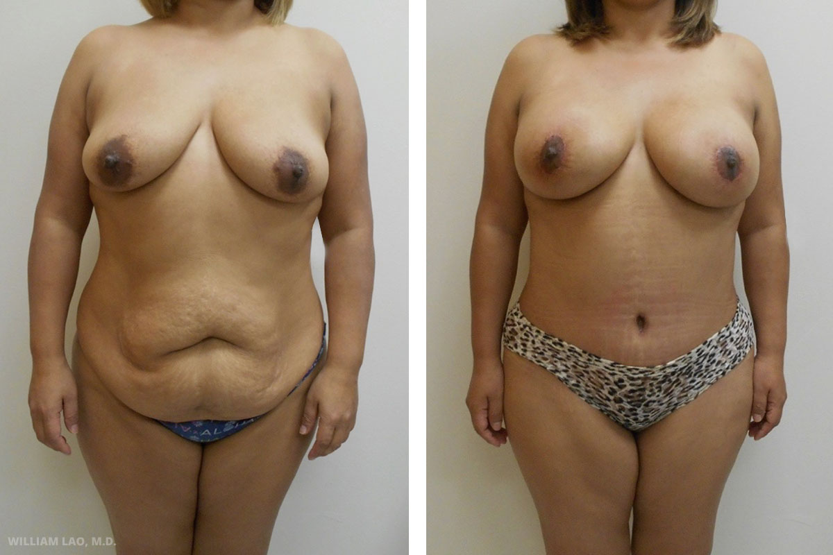 Mommy makeover before and after results as performed by Manhattan plastic surgeon Dr. William Lao