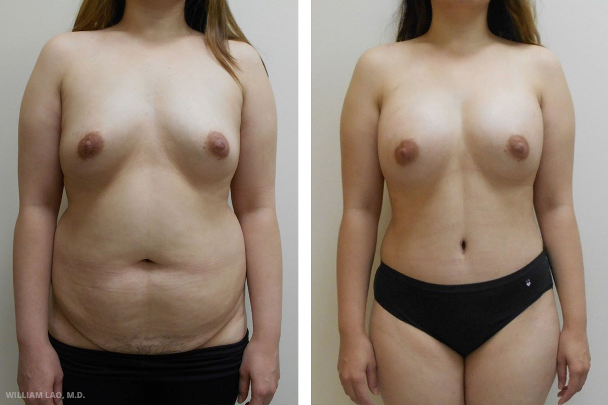 Mommy makeover before and after results as performed by Manhattan plastic surgeon Dr. William Lao