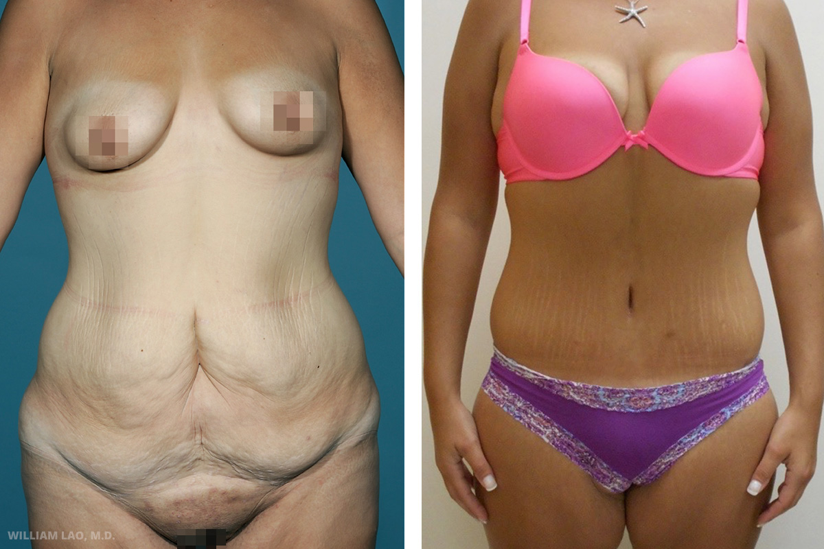 Before and After Weight Loss Surgery Manhattan