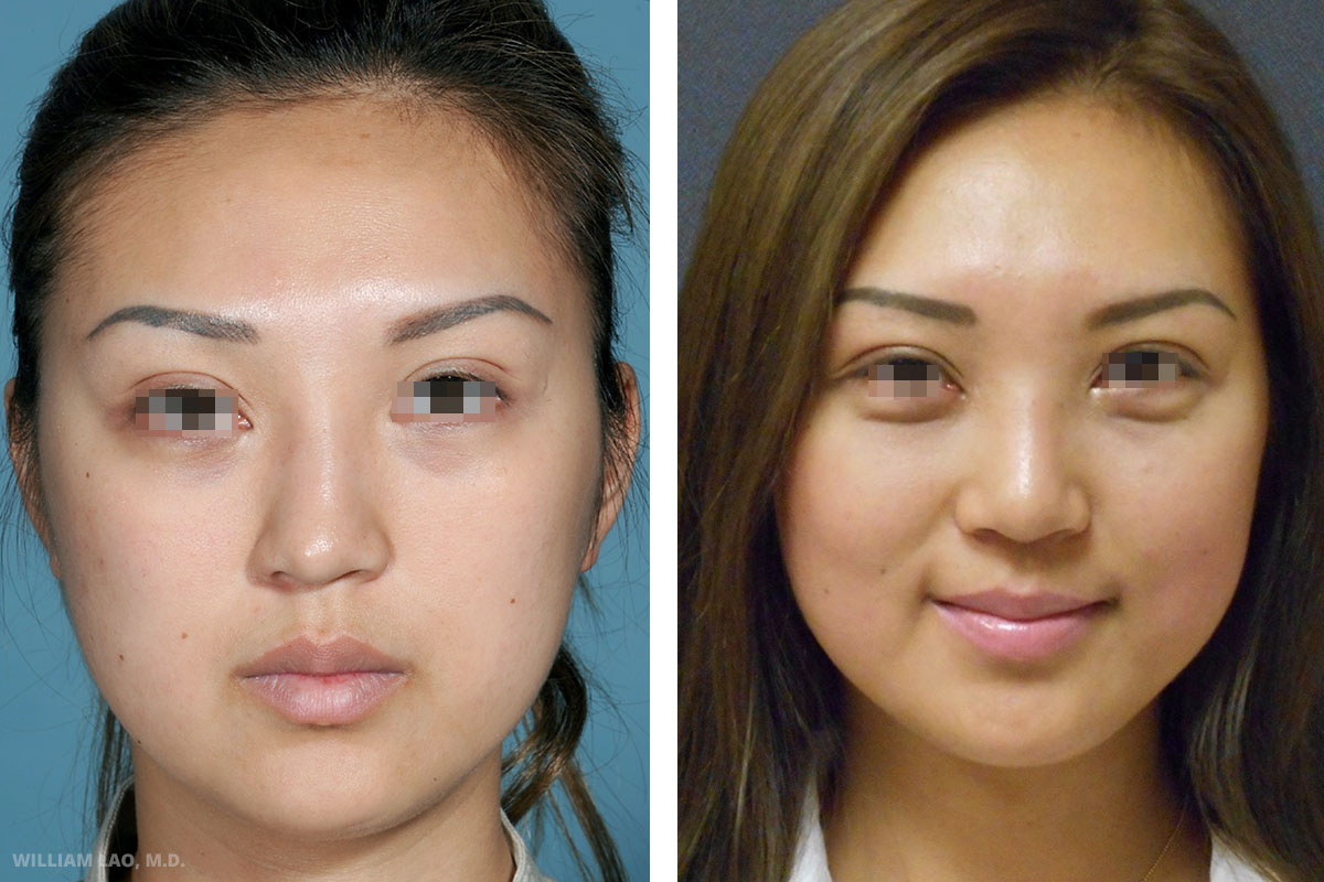 Before and After results of a rhinoplasty performed by Manhattan plastic surgeon Doctor William Lao
