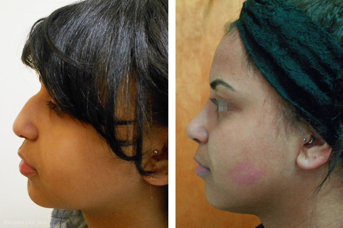 Nose Surgery New York City Rhinoplasty Manhattan