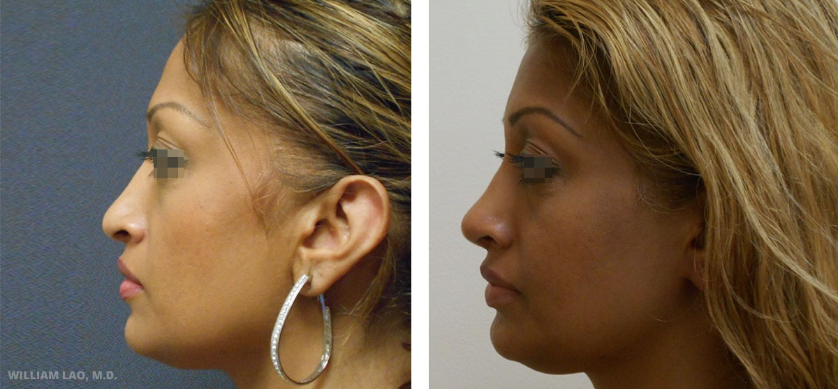 Rhinoplasty New York City Asian Augmentation Rhinoplasty