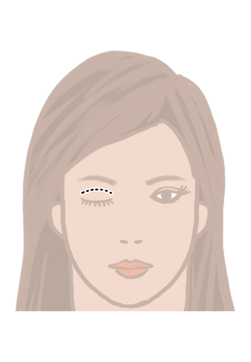 Incision Technique for Upper Eyelid Blepharoplasty