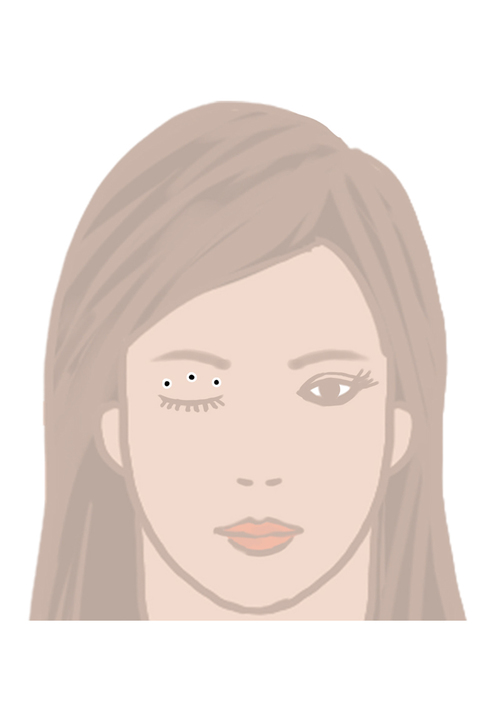Suturing Technique for Upper Eyelid Blepharoplasty