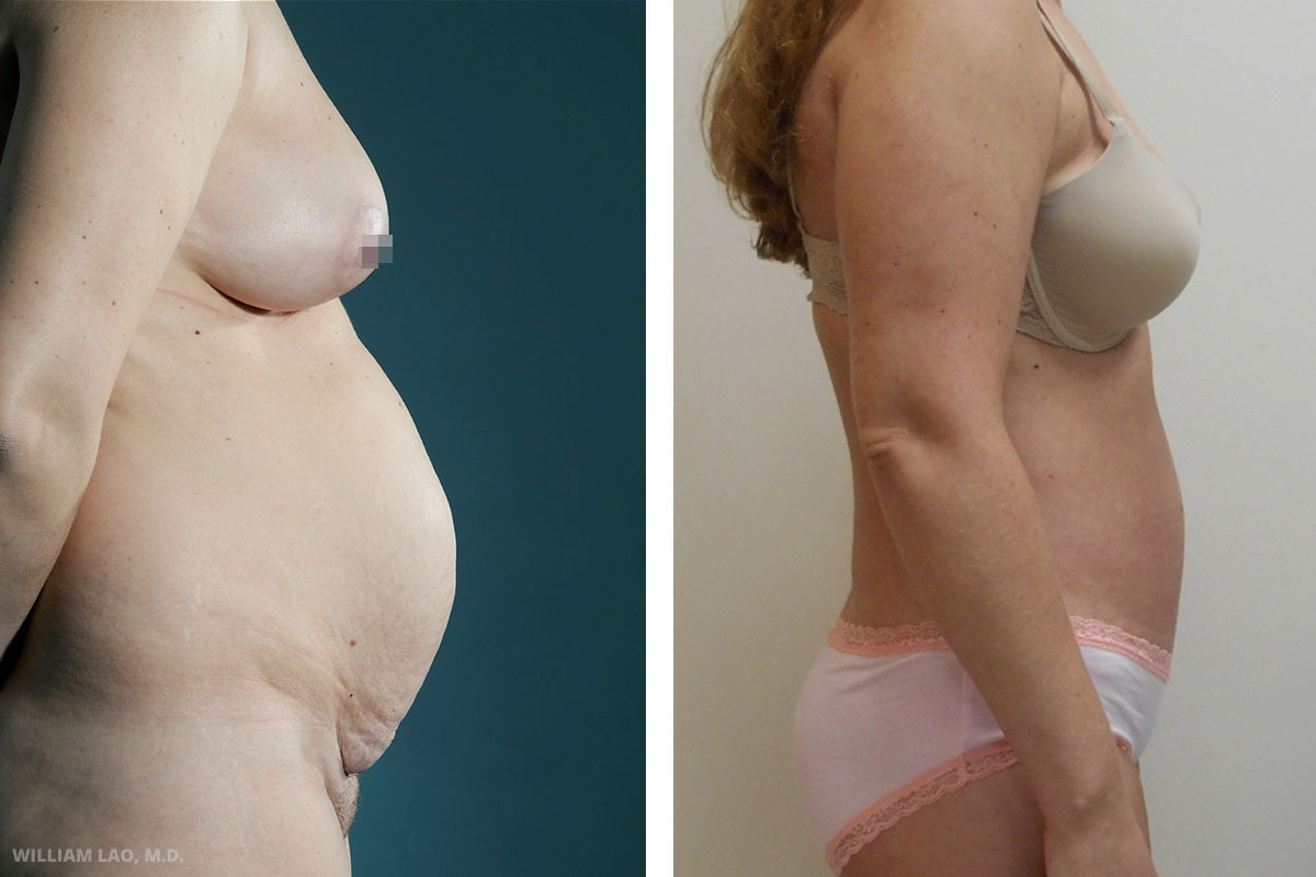 Tummy tuck results before and after as performed by Manhattan plastic surgeon Dr. William Lao
