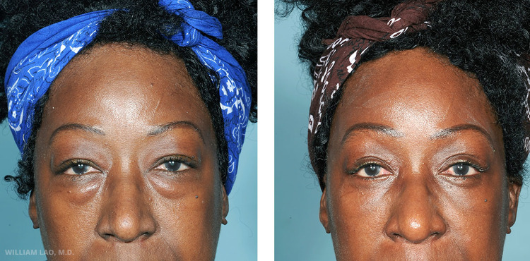 Before and After results of a Lower Eyelid Blepharoplasty or eye bag removal performed by New York plastic surgeon Doctor William Lao