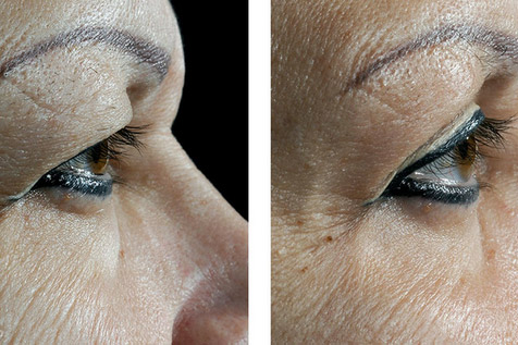 Before and after result of a patient that had an upper eyelid blepharoplasty performed by Manhattan plastic surgeon Doctor William Lao