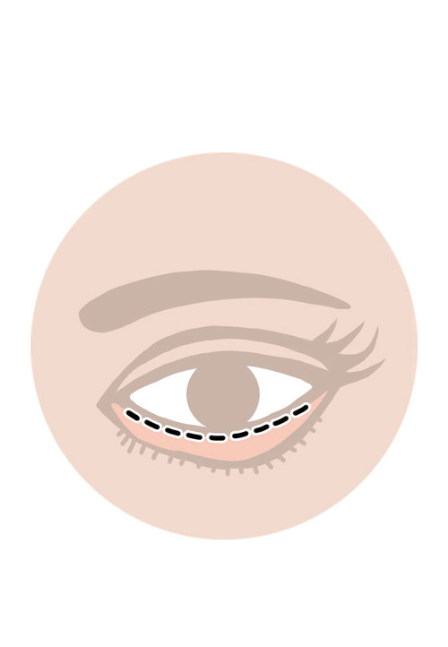 Lower Eyelid Blepharoplasty incision hidden inside of the lower lid