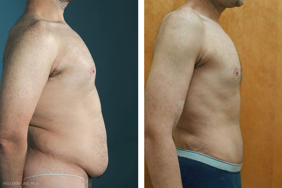 Tummy tuck results before and after as performed by Manhattan plastic surgeon Dr. William Lao