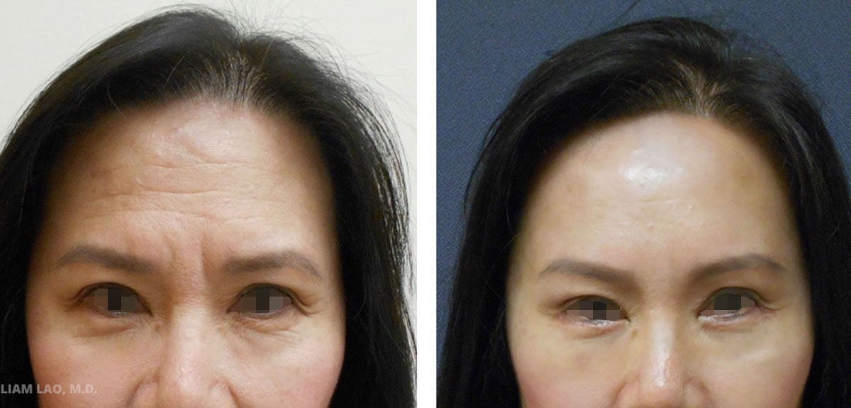 Before and After results of a brow lift performed by New York surgeon Doctor William Lao