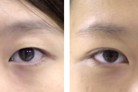 Before and after result of a patient that had an upper eyelid blepharoplasty performed by Manhattan plastic surgeon Doctor William Lao