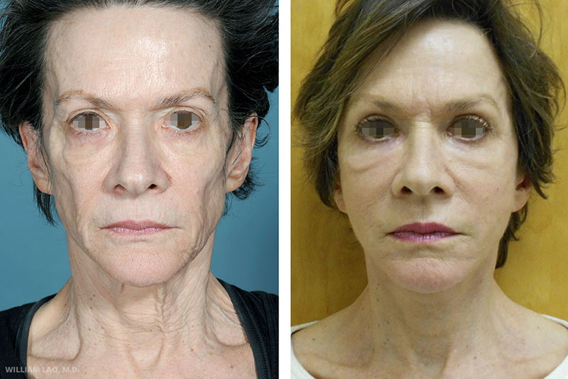 Before and After results of a patient who received facelift by New York plastic surgeon Doctor William Lao