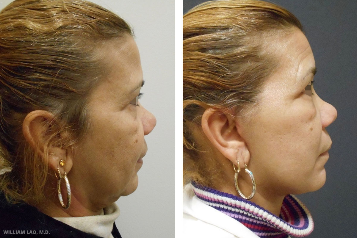 Before and After results of a patient who had a neck lift performed by Manhattan plastic surgeon Doctor William Lao