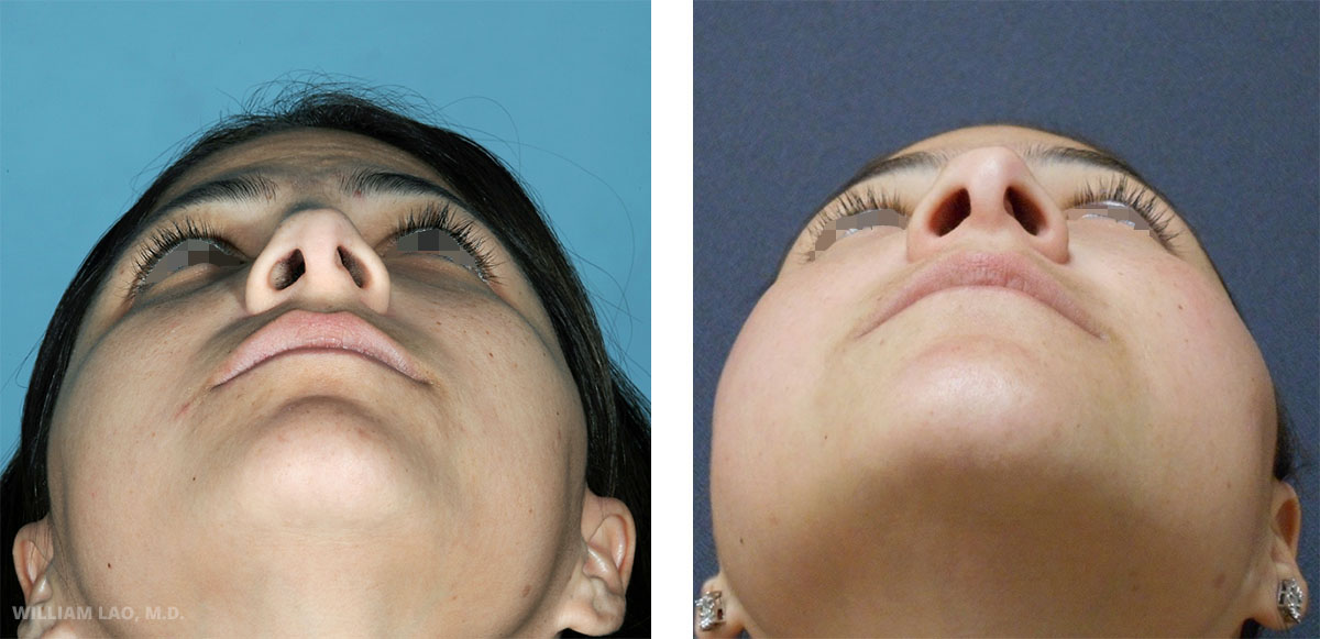Rhinoplasty New York City Asian Rhinoplasty Manhattan