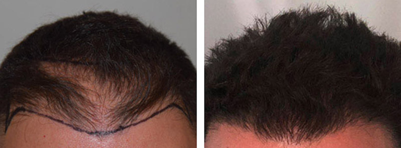Before and After Hair Transplant NYC