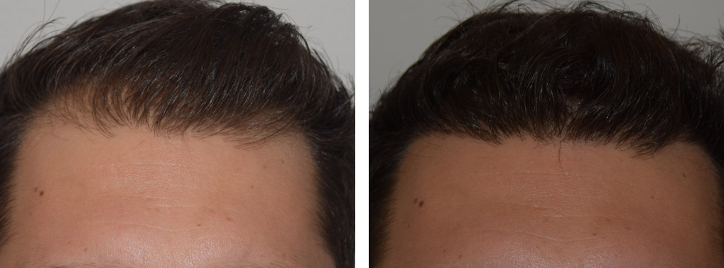 ニューヨークで植毛なら Lao William Doctorlao Com