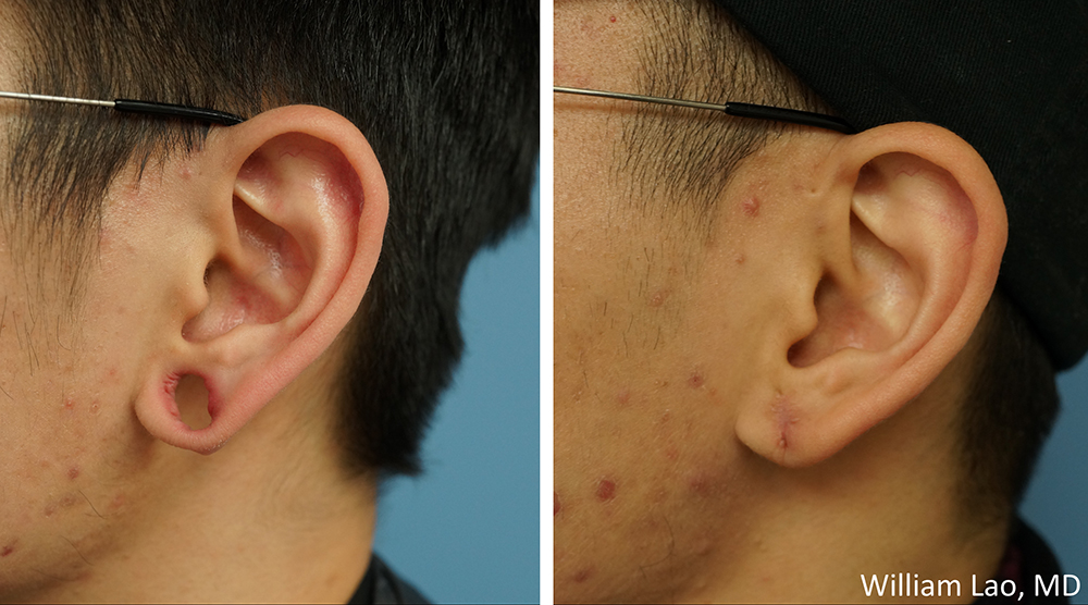 Before and After Earlobe Repair NYC