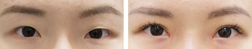 Asian Double Eyelid Surgery Results