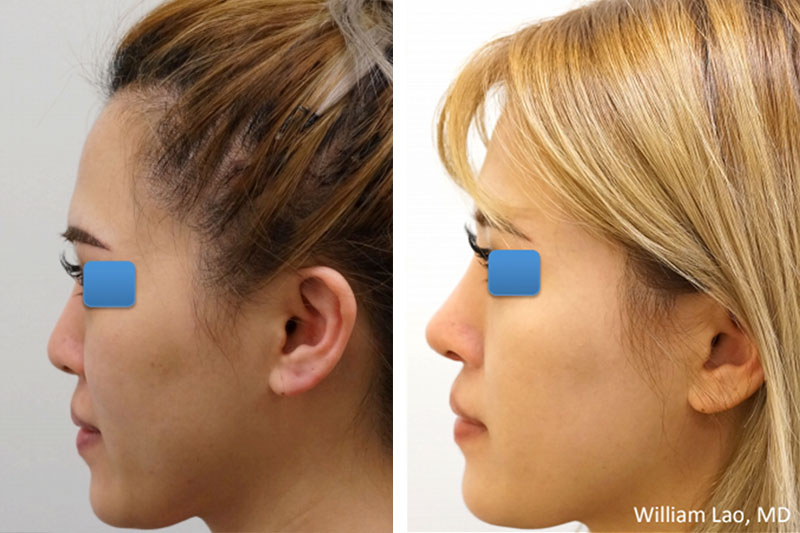 Before and After results of a patient who received asian rhinoplasty by New York plastic surgeon Doctor William Lao