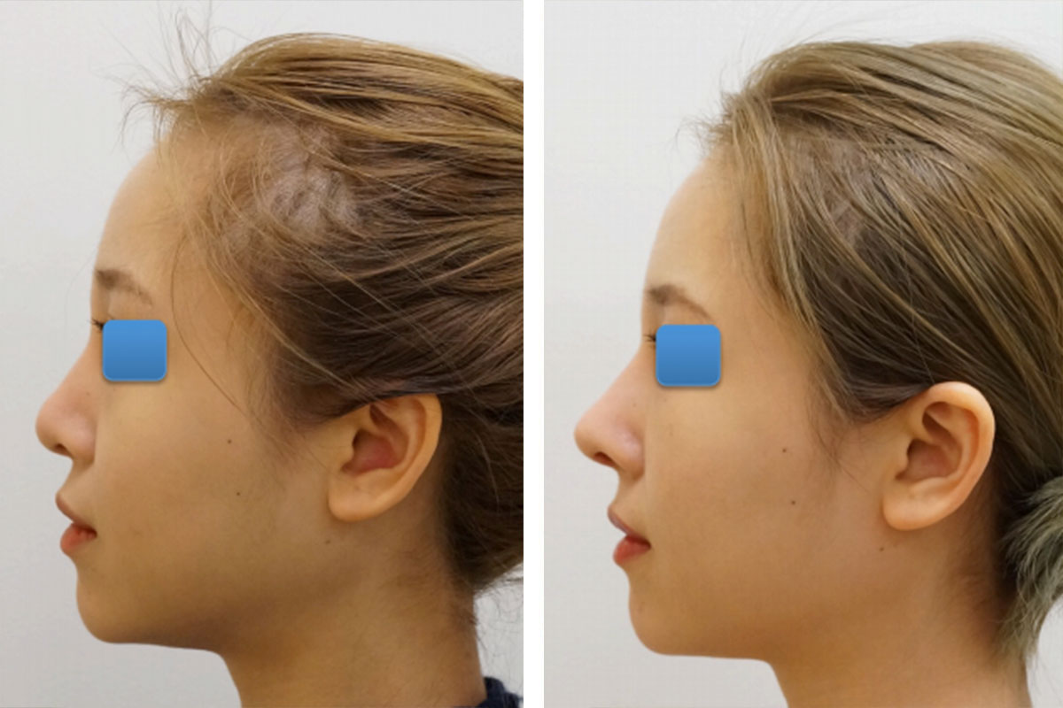 Asian Rhinoplasty New York City Ethnic Rhinoplasty Manhattan
