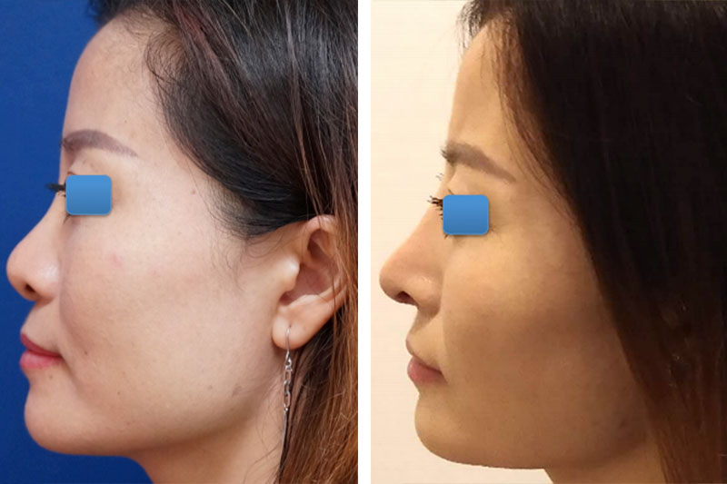 Before and After results of a patient who received asian rhinoplasty by New York plastic surgeon Doctor William Lao