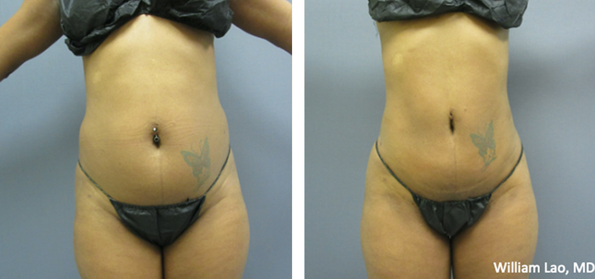 Liposuction before and after results as performed by New York City plastic surgeon Dr. William Lao