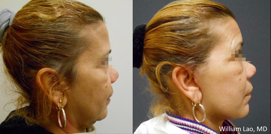 Before and After results of a patient who received jawline contouring by New York plastic surgeon Doctor William Lao