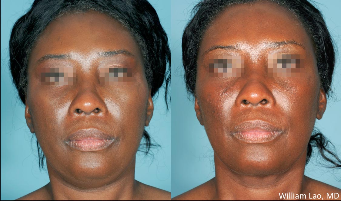 Jawling Contouring Before & After Results